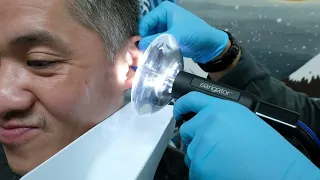 Earwax Removal when Over-the-Counter Products Did Not Work