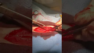 suturing the linea using simple interrupted pattern