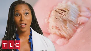 Patient's Toes Are Covered in Tumors | My Feet Are Killing Me