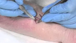 How to Suture - part 4: the Z plasty