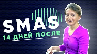 SMAS. 14 дней после операции