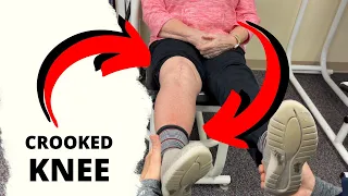 Crooked Knee ??? After Total Knee Replacement 🔴 LIVE