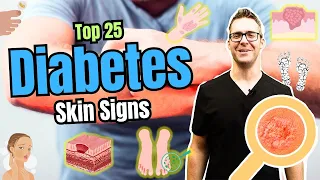 Top 25 Skin Signs & Symptoms of Diabetes [Type 2 Diabetes Early Signs]