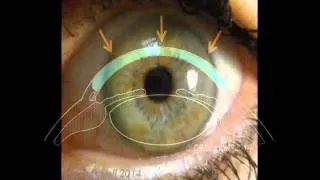 Cornea 1: A Remarkable Structure