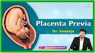 Placenta Previa: Etiology, Pathophysiology, Clinical presentation, Diagnosis and Treatment