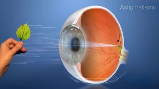 ¿Qué es el astigmatismo? ¿Cómo ve un astigmático?