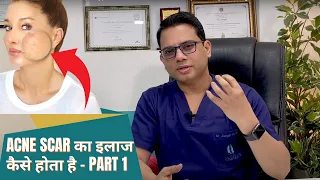 Acne scar treatment procedure? Part -1  - Explained by Dr. Jangid | SkinQure | Delhi