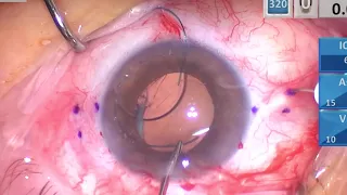 Scleral Fixating Existing Dislocated Tecnis IOL. Why Is It Difficult to Yamane Certain 3-Piece IOLs?