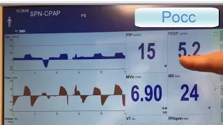 Draeger V500: Measuring P0.1, Pocc, and Delta-P