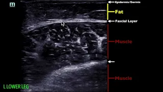 POCUS - Soft Tissue Ultrasound - Soft Tissue Edema