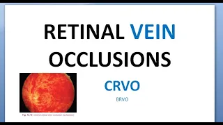 Ophthalmology CRVO Central Retinal Vein Occlusion Splashed tomato Thunder Ischemic RAPD glaucoma