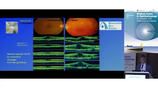 Oct in diabetic retinopathy: James Talks