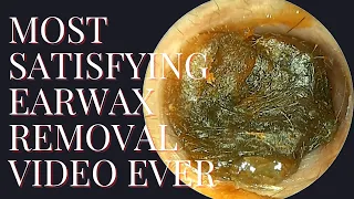 Most SATISFYING Earwax Removal Video EVER !!!