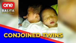 Conjoined twins, isinilang sa Oriental Mindoro