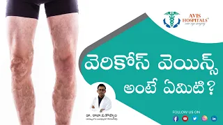 What Is Varicose Veins Explained By Dr. Rajah V Koppala | Avis Hospitals