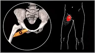 Sore groin and thigh. Comb muscle and myofascial pain syndrome