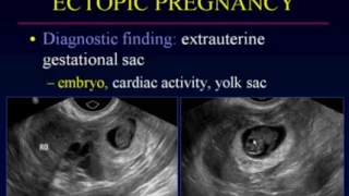 Sonographic Evaluation of Ectopic Pregnancy