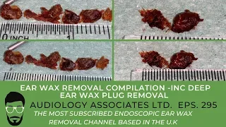 EAR WAX REMOVAL COMPILATION - INC DEEP EAR WAX PLUG REMOVAL - EP 295