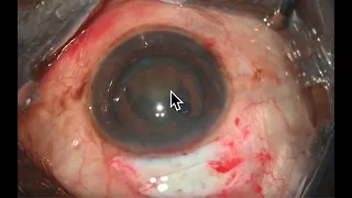 Surgery: Manual Small Incision Cataract Surgery (MSICS): The Aravind Way