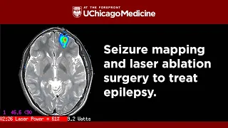 Stopping Seizures: Seizure Mapping and Laser Ablation Surgery for Epilepsy