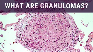 What are Granulomas? - Pathology mini tutorial