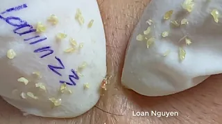 Removal blackheads by Loan Nguyen (n23a)