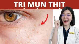 Cách TRỊ MỤN THỊT | Trị mụn tại nhà | Thạc sĩ - Bác sĩ Phương Quý