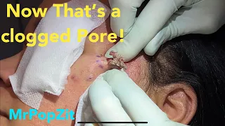 Now that’s a clogged pore! Large face bump removed and closed with running sub-cuticular stitch.