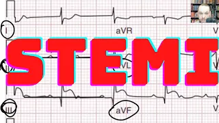 How to Interpret STEMI 12 Lead ECG correlated Coronary Anatomy with Cases Part 2