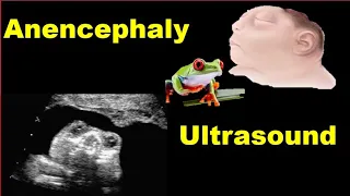 Anencephaly Ultrasound