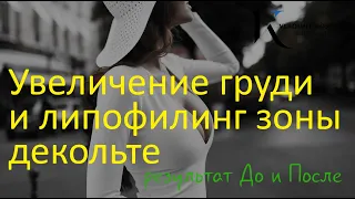 Увеличение груди имплантами и липофилинг зоны декольте - хирург Владимир Косинец