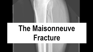 The Maisonneuve Fracture