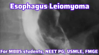 Esophageal Leiomyoma For MBBS students, Neet PG, Usmle, FMGE I Neet PG Usmle Preparation