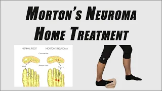 How to Get Rid of Pain from Morton's Neuroma | Best Movements and Tips