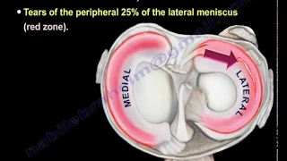 meniscus tear  , knee injury ,lateral meniscus    - Everything You Need To Know - Dr. Nabil Ebraheim