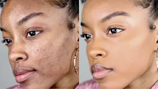 How to cover acne/dark spots WITHOUT a lot of makeup | Slim Reshae