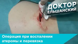 Операция при воспалении атеромы и перевязка