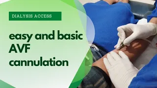 AVF Cannulation Video | Cannulating Easy and Basic AVF access