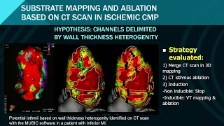 PR2023, MARCH 20 - Ablation of ventricular arrhythmias 3