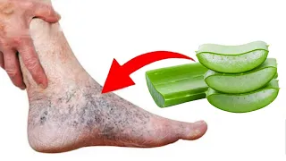 Say goodbye to varicose veins and heavy legs with just this 100% effective aloe vera leaf