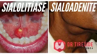 Sialolitíase e Sialoadenite  | Dr Jônatas Catunda