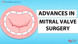 Mitral Valve Surgery: Advances in Minimally-Invasive & Transcatheter Procedures with Dr. Chikwe