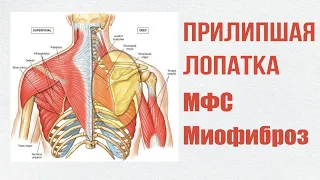 Прилипшая лопатка. Миофиброз. МФС. Лечение у врача Ямбаева Рафаэля Рифатовича, Казань