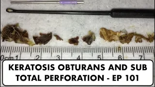 EAR WAX REMOVAL KERATOSIS OBTURANS AND SUB TOTAL PERFORATION - EP 101