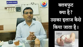 Clubfoot/ CTEV treatment / टेड़े मेड़ें पाँव का इलाज