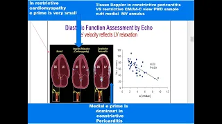 1 Hallmarks of constrictive pericarditis Echo case study