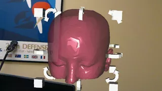 Brain Surgery Planning with RadHA Augmented Reality app