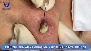 TỔNG HỢP NHỮNG CA NẶN MỤN VIÊM TỤ CẦU, MỤN NANG CHAI TẠI PHÒNG KHÁM DA LIỄU HHV CLINIC.