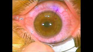 Lasik Eye Surgery