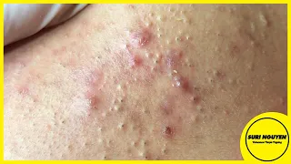 Suri Job 56: AWESOME BLACKHEADS FIELD